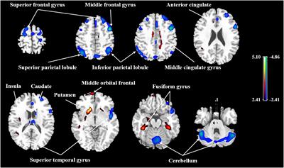 The Age-Related Perfusion Pattern Measured With Arterial Spin Labeling MRI in Healthy Subjects
